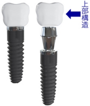 インプラント上部構造