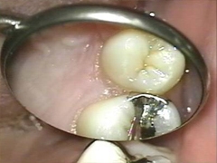 マイクロスコープミラーレステクニック