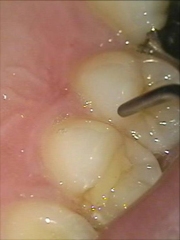 マイクロスコープミラーレステクニック