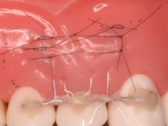 歯周再生治療~パッチテクニック~