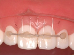 歯周再生治療~パッチテクニック~