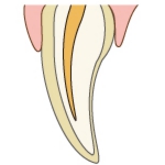 ラミネートべニア