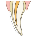 ラミネートべニア