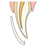 ラミネートべニア