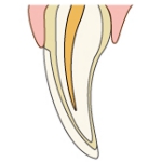 ラミネートべニア