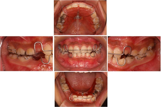 小児矯正治療後